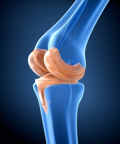 knee implant 1